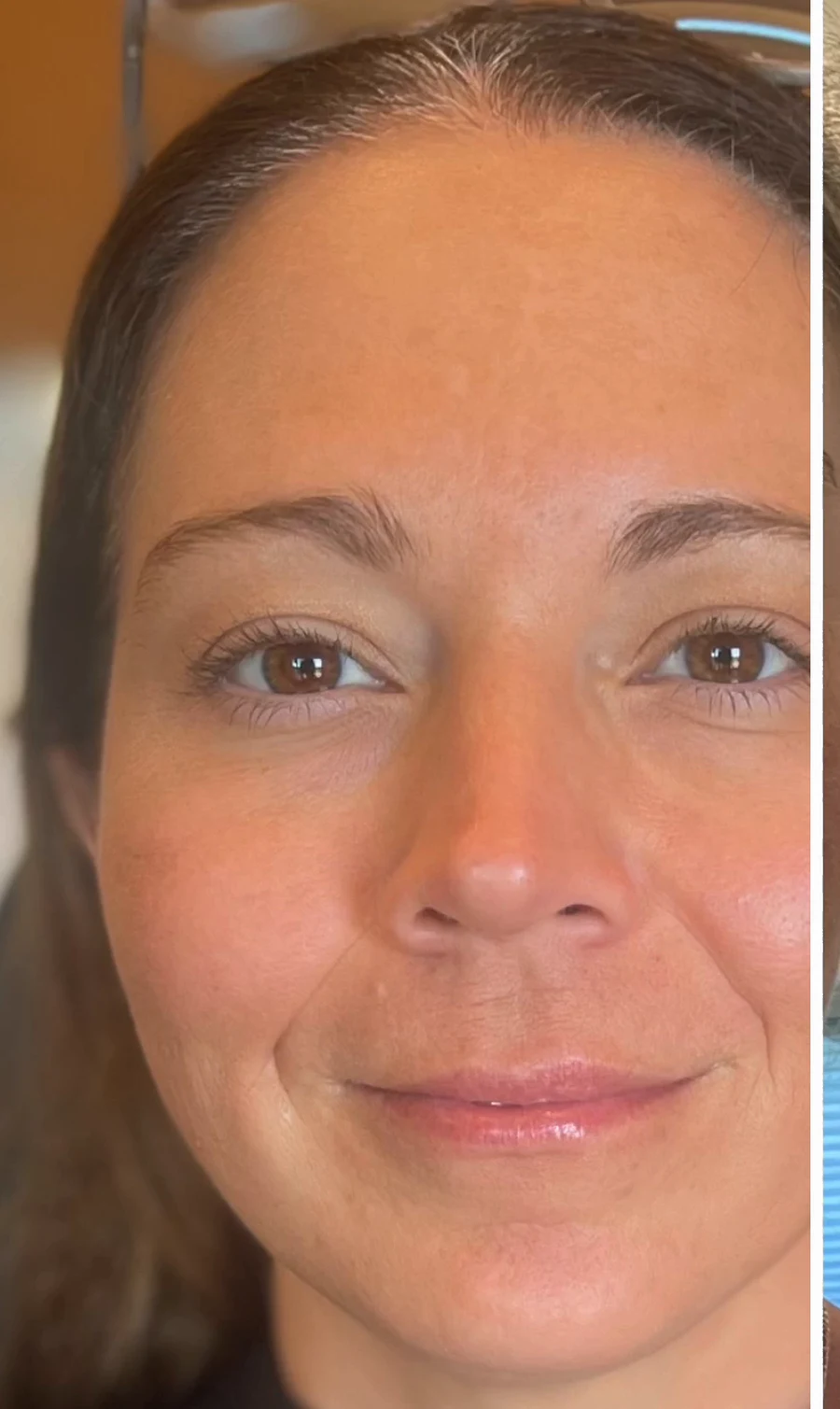 After microneedling, Dysport and medical-grade skincare: even tone, smoother texture and softened expression lines